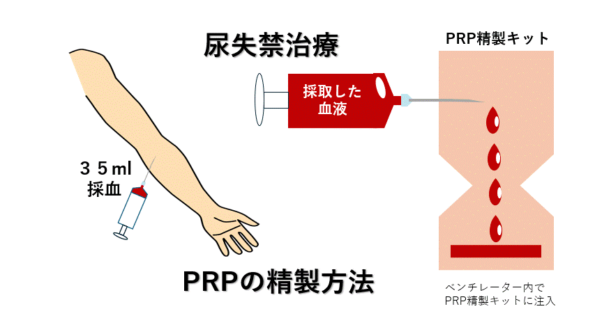 PRPの精製方法