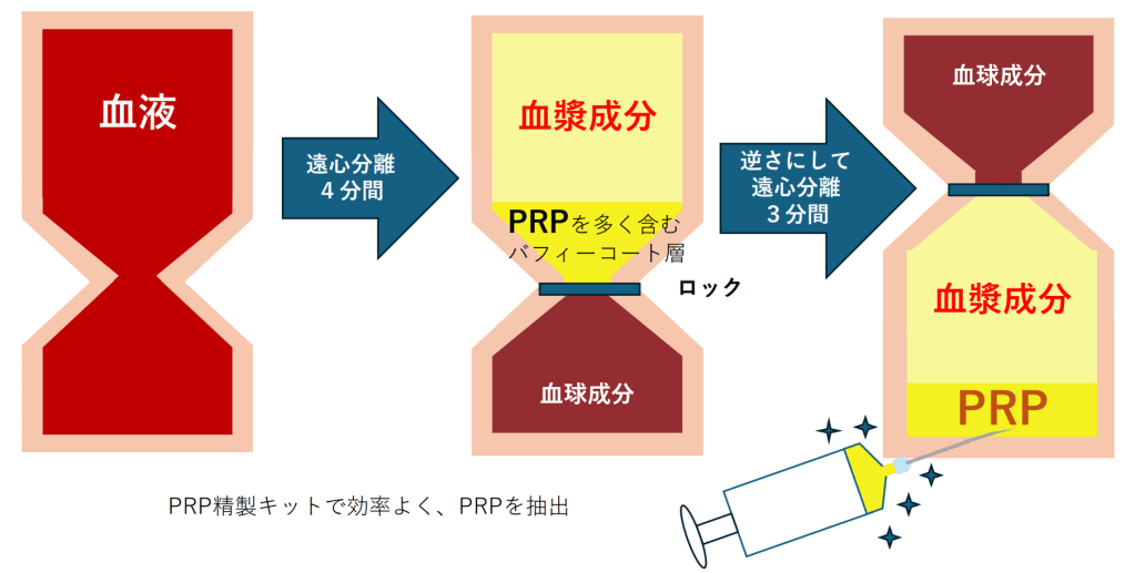 PRP（多血小板血漿）の抽出プロセスを示した図。血液を遠心分離し、血漿成分と血球成分に分ける説明が含まれている。