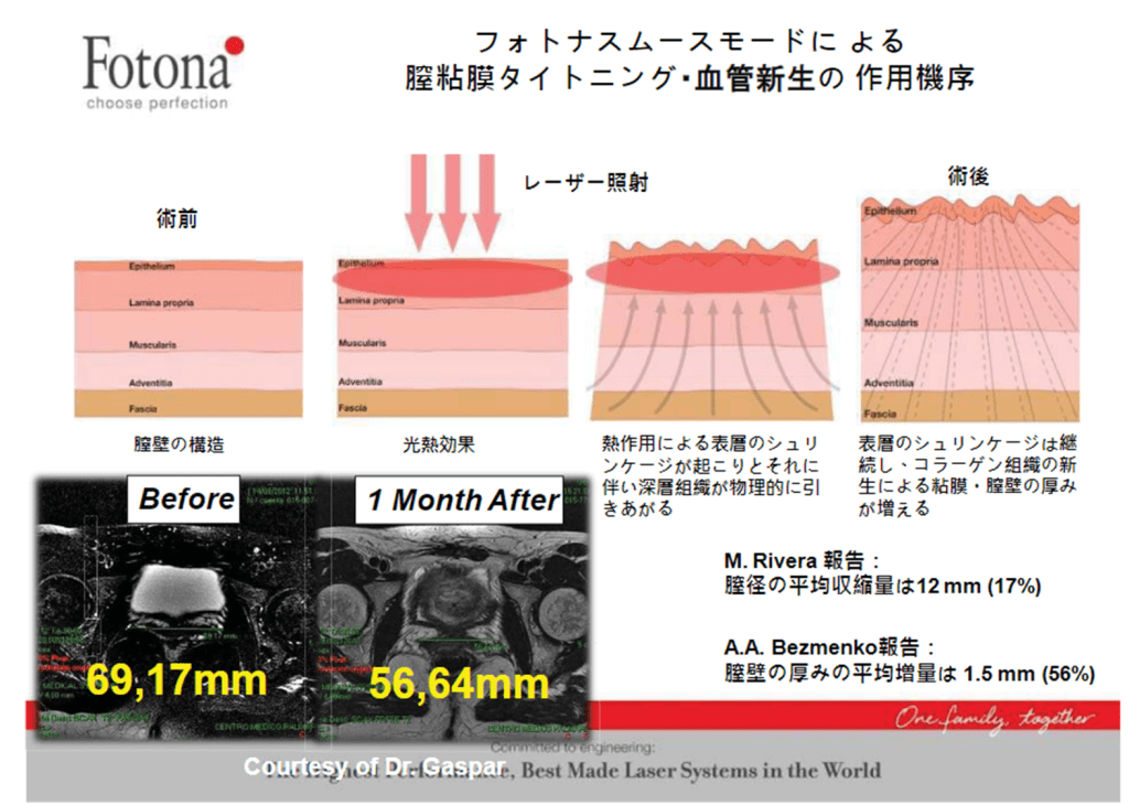 フォトナスムースモードの効果を示す図。術前と術後の膣壁の構造の比較と、レーザー照射による組織の変化を解説した内容。