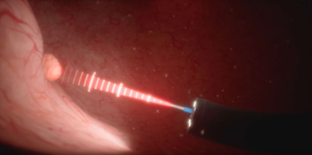 膀胱の内部でレーザーを使用して腫瘍を蒸散している様子。